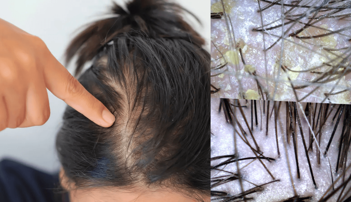 keratin plugs 